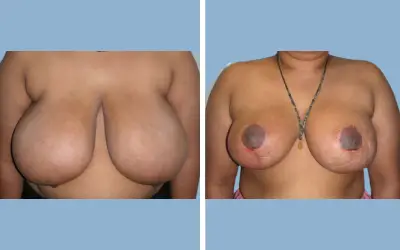 Before and After